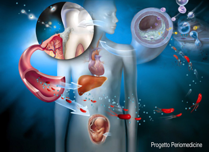 Parodontite e malattie cardiovascolari: la relazione pericolosa